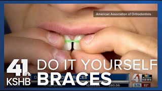 DIY Braces [upl. by Markos]