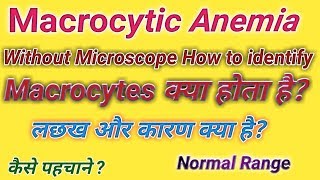 Macrocytic anemia  Microcytic anemia  Anemia in hindi [upl. by Gian]