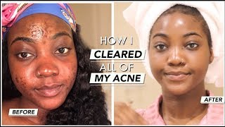 HOW I CLEARED UP MY ACNEACNE SCARS  SKINCARE JOURNEY [upl. by Holey956]