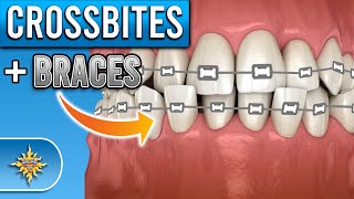 How Do BRACES Fix Crossbites [upl. by Ashbaugh]