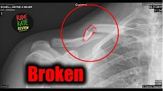 I Crashed amp Broke My Collarbone  My Road to Recovery [upl. by Jeconiah]