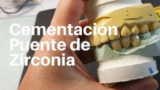 PUENTE de ZIRCONIA👅 Posterior CEMENTACION Puentezirconia Puentedental [upl. by Ttej101]