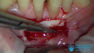 Innesto gengivale libero  free gingival graft [upl. by Anilec18]