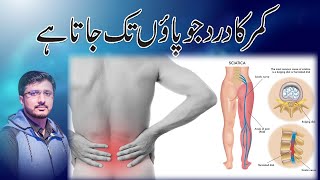 Sciatica amp Leg Pain in UrduHindi  backache sciatica by dr mohsin [upl. by Tuppeny]