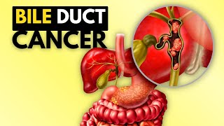 BIle Duct Cancer Cholangiocarcinoma Causes Signs and Symptoms Diagnosis and Treatment [upl. by Yelrah947]