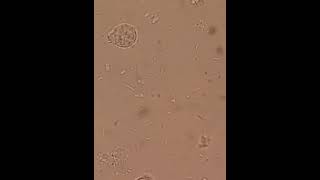 Trophozoite and cyst stage of Entamoeba histolytica in the stool test [upl. by Iphlgenia]