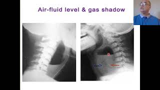 Retropharyngeal abscess Prevertebral abscess Acute n chronic retropharyngeal abscess [upl. by Aitnis]