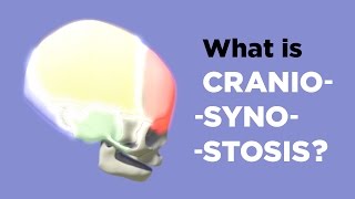 What is Craniosynostosis [upl. by Annehs]