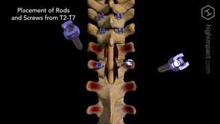 Open Reduction Internal Fixation of T4 with Posterolateral Fusion from T2 to T7 [upl. by Eggett]