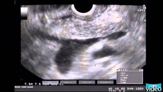 Diagnosis of Pancreas Divisum Using LinearArray Endosonography [upl. by Assyn]