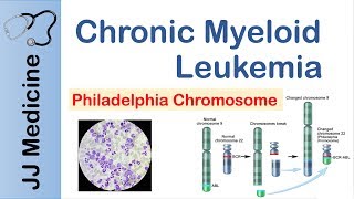 Chronic Myeloid Leukemia CML  Pathogenesis Symptoms and Treatment [upl. by Rehpotsirhcnhoj541]