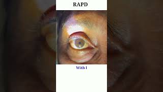 RAPD testing  Optic nerve test  Swinging flash light test eyecareoptom shorts rapd short eye [upl. by Maurice]