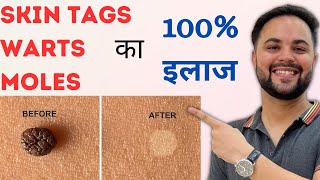 Skin Tags Warts amp Moles का 100 इलाज with Home Remedies [upl. by Ahsimed]