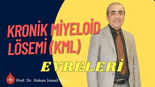 Kronik Miyeloid Lösemi KML Evreleri  KML Fazları [upl. by Gainor]