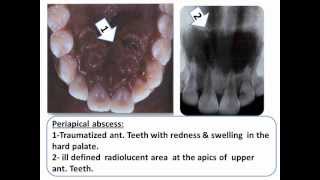 Periapical Diseases Oral Pathologywmv [upl. by Kaufman]