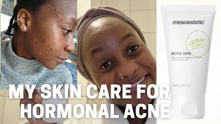 JINSI YA KUTIBU CHUNUSI HORMONAL ACNE TREATMENT ROUTINE [upl. by Buck]