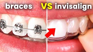 Invisalign vs Braces what you NEED to ask your dentist [upl. by Sunil]