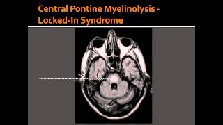 Central Pontine Myelinolysis  LockedIn Syndrome [upl. by Demahom467]