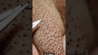 Satisfying Pimple Popping [upl. by Oigres737]