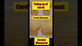 Taking up of cervixCervical Effacementobstetricsandgynecology medicalshorts [upl. by Janik]