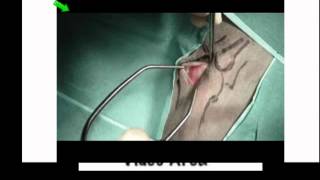 How To Perform A Cancellous Bone Graft [upl. by Llewol]