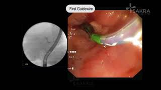 ERCP Procedure Video  Best Gastroenterologist in Bangalore  Dr Dinesh Kini  Sakra World Hospital [upl. by Laohcin]