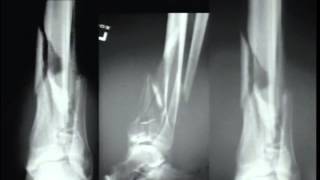 Pilon Fractures Management Options [upl. by Towney]