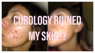 CUROLOGY MADE MY ACNE WORSE I Honest 5 Month Review [upl. by Annahahs]