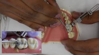 Amalgam Fill Restoration Walkthrough tutorial  Simulation Clinic Demonstration [upl. by Akinajnat281]