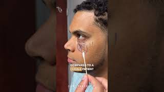 Lower Eye Bag Removal For Males with Dr Kami Parsa  Trifecta Lift [upl. by Cranston288]