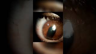 COLOBOMA bilateral [upl. by Nashner954]