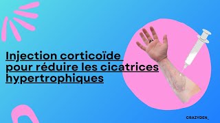 Injection corticoïde pour réduire les cicatrices hypertrophiques Ftm trans français  CRAZYDEN [upl. by Nnyleimaj]