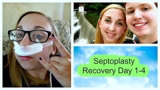 Septoplasty Recovery Day 14 [upl. by Notyap]