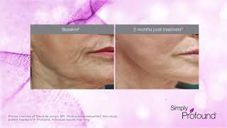 Profound RF Microneedling NonSurgical Facelift Long Island Manhattan NYC [upl. by Aynwat]