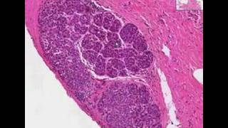 Histopathology BreastLobular carcinoma in situ [upl. by Verdie]