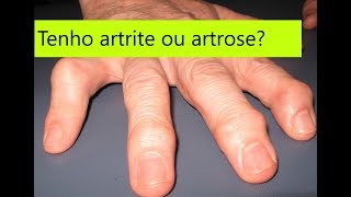 Como diferenciar artrose de artrite nas mãos guia simples e completo [upl. by Yna]