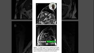 Identificación de Fibrosis Miocárdica en Resonancia Magnética [upl. by Annekam829]