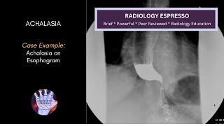 ACHALASIA Case Example  ACHALASIA of an Esophagram 4630 [upl. by Honniball]