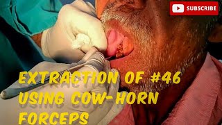 Root Preservation Molar Tooth 46 Extraction using CowHorn Forceps toothextractions dental [upl. by Alien537]