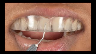 Direct composite veneers  Injection moulding technique  Complete Digital Workflow [upl. by Hanikehs20]