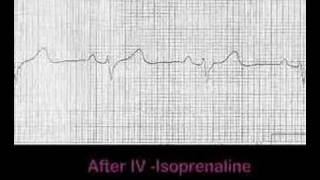 Temporary medical pacing [upl. by Markiv97]