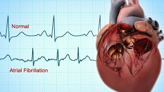 MM  Medical Cardioversion of Atrial Fibrillation in the ER [upl. by Letnuahc959]