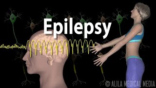 Epilepsy Types of seizures Symptoms Pathophysiology Causes and Treatments Animation [upl. by Hael]