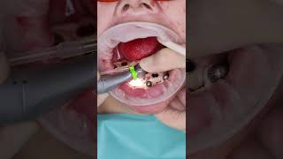 Dental implant’s All on 4 in Prague shorts dentist dental implant veneers short [upl. by Lladnar]