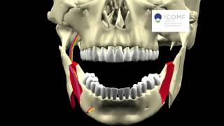 AVANCE MANDIBULAR OSTEOTOMIA SAGITAL [upl. by Htur]