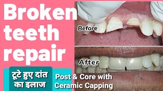 Broken teeth repair  Front teeth ceramic capping  टूटे हुए दांत का इलाज  Post amp Core build up [upl. by Ullyot947]