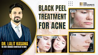 Black Peel Treatment for acne  Acne Treatment Facial Peel  Before and After Result [upl. by Phillipe]