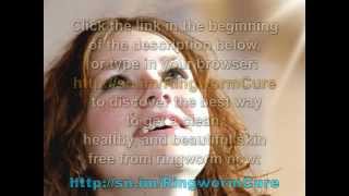 Ringworm Removal  Remove Ringworm in Humans [upl. by Ahsilahs]