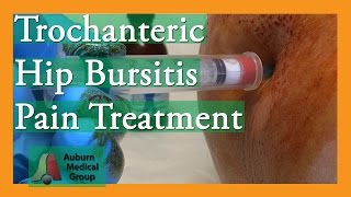 Trochanteric Hip Bursitis Pain Treatment  Auburn Medical Group [upl. by Cullin]