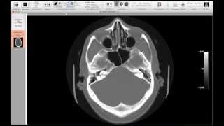 Christopher Hess MD PhD Neuroimaging Part 2 Fundamentals of Image Interpretation [upl. by Idalina]